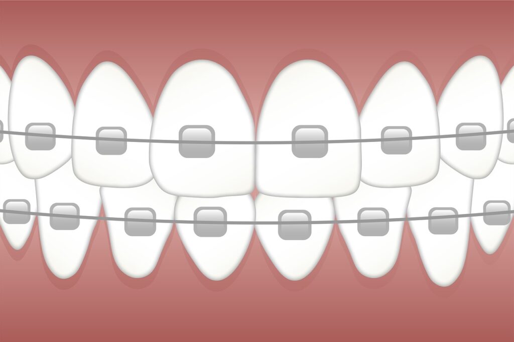 braces, teeth, dentist-3597591.jpg